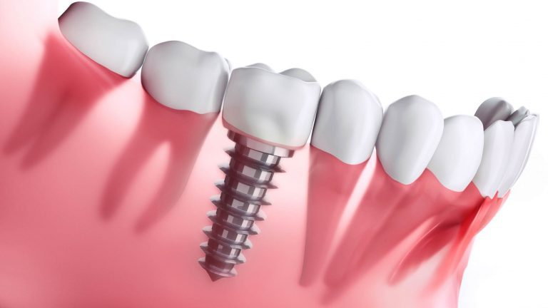 implantes dentales en Saltillo