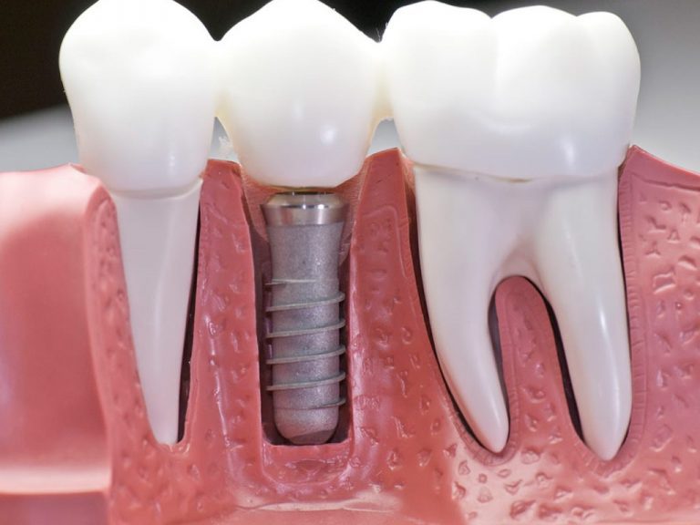 Ventajas de los implantes dentales